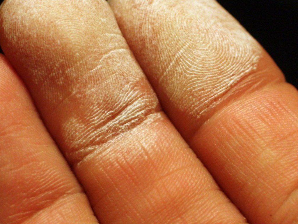 ustioni acqua ossigenata